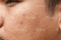 Расширенные поры на лице: причины их появления и варианты уменьшения пор